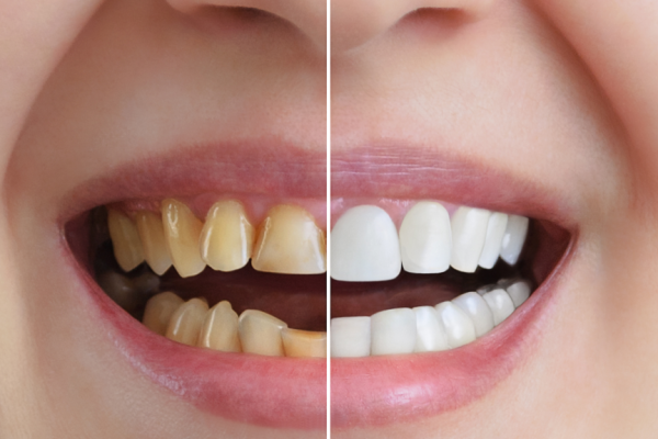 floruvanny-zubiv-ternopil.