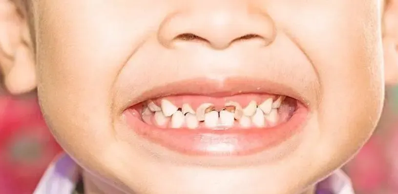 likuvannya-kariesu-molochnyh-zubiv-ternopil-1